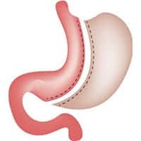 quelle imc pour bypass quelle différence entre bypass et sleeve centre obesite est essonne docteur girodet matthieu docteur bassam tantawi obesite paris quelle imc pour bypass quelle différence entre bypass et sleeve centre obesite est essonne docteur girodet matthieu docteur bassam tantawi obesite paris